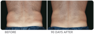 Cool-lipo-before-and-after-man