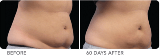 Cool-lipo-before-and-after-woman