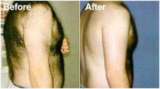 Laser-hair-removal-before-after