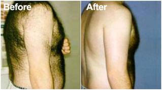 Laser-hair-removal-before-after Laser-hair-removal-before-after