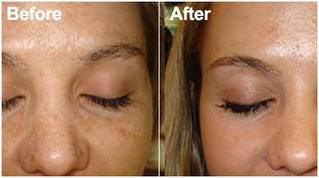 Pigmentation-therapy-1-treatment-copy