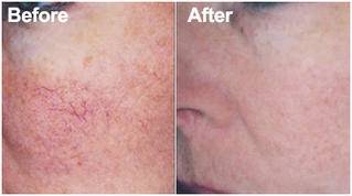 Vascular-treatments Vascular-treatments