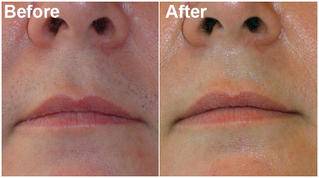 Before-after-upperlip