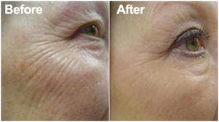 Skin-rejuvenation Skin-rejuvenation